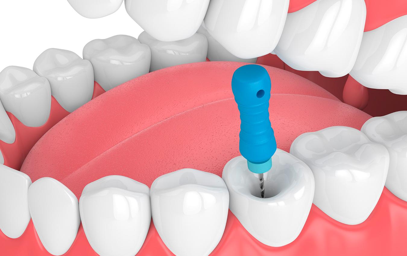 Root Canal Treatment