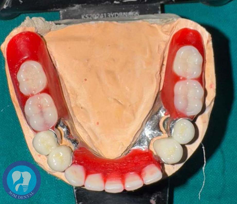 Cast Partial Dentures Gallery 4
