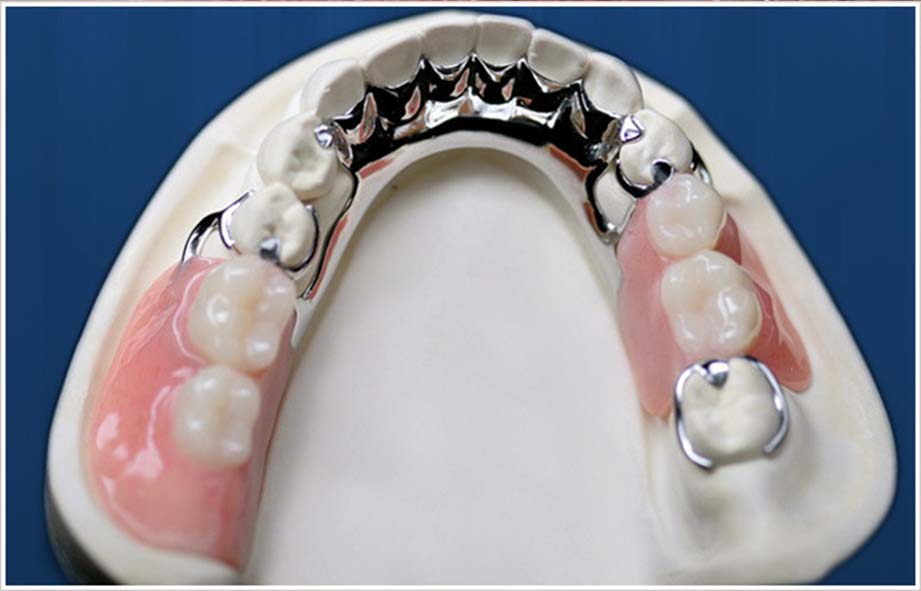 Cast Partial Dentures Gallery 7