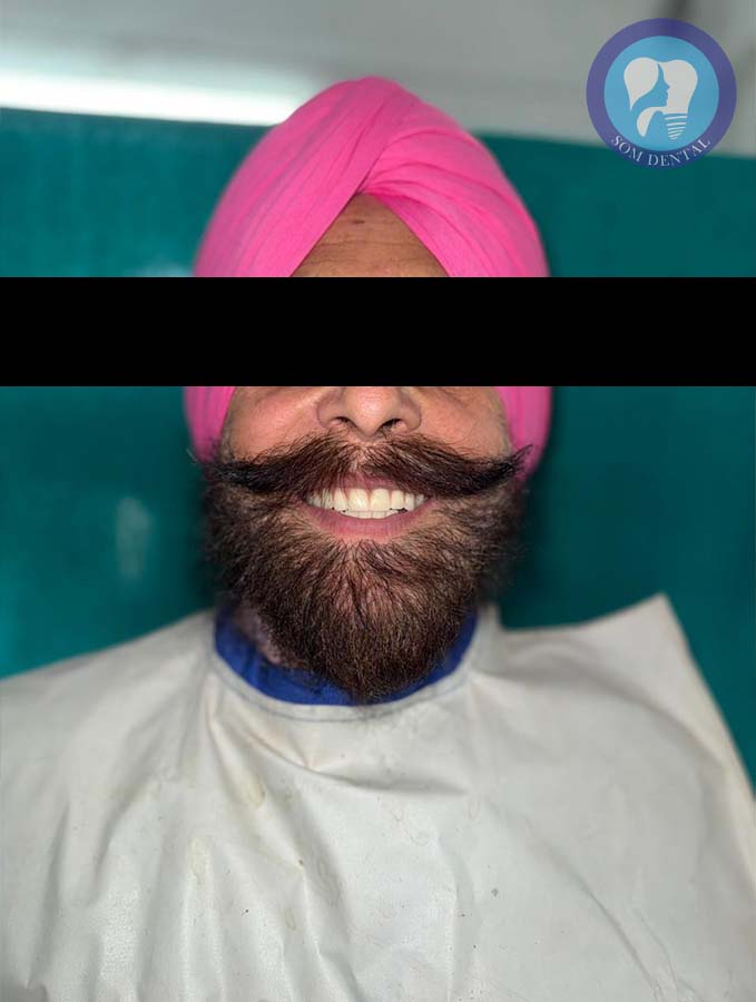 Cast Partial Dentures Gallery 8