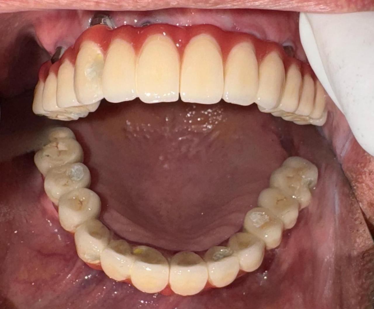 Implant Case 2