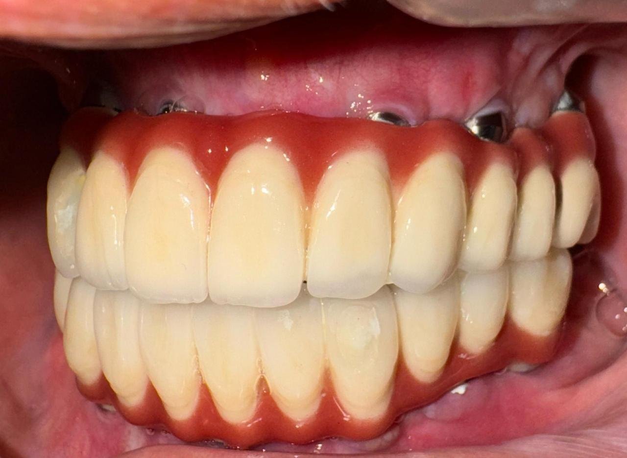 Implant Case 4