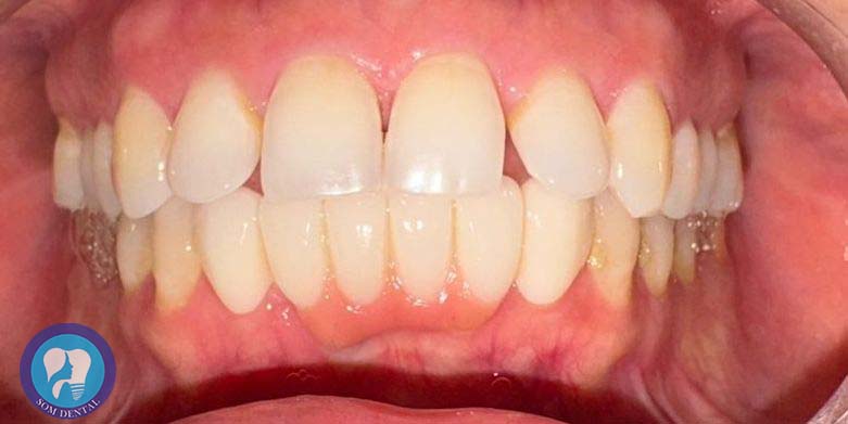 Laminates Veneers Gallery 1