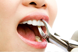 Tooth Extraction